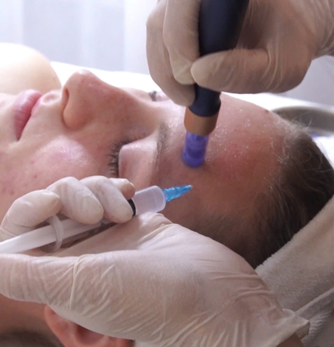 Điều trị bằng công nghệ Skin Pen tại HBIO Clinic