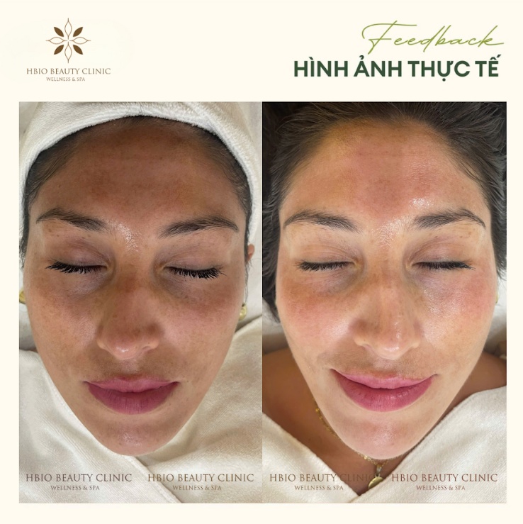 Điều trị peel da tại HBIO Clinic