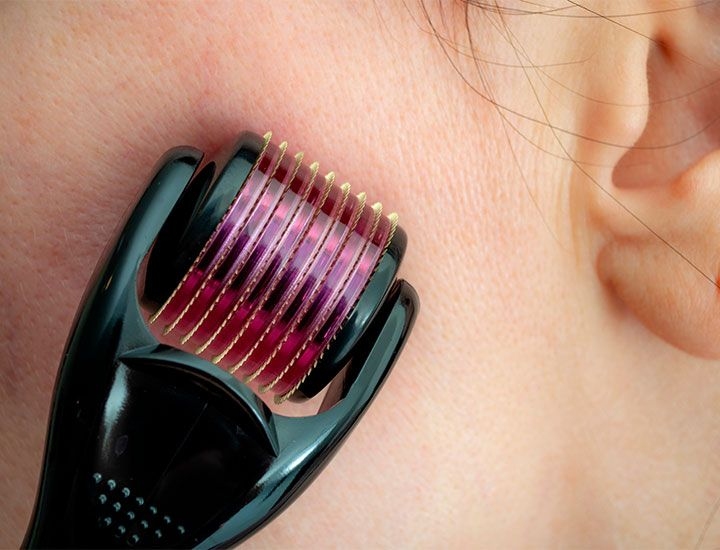 Điều trị sẹo sau thủy đậu bằng phương pháp lăn kim 