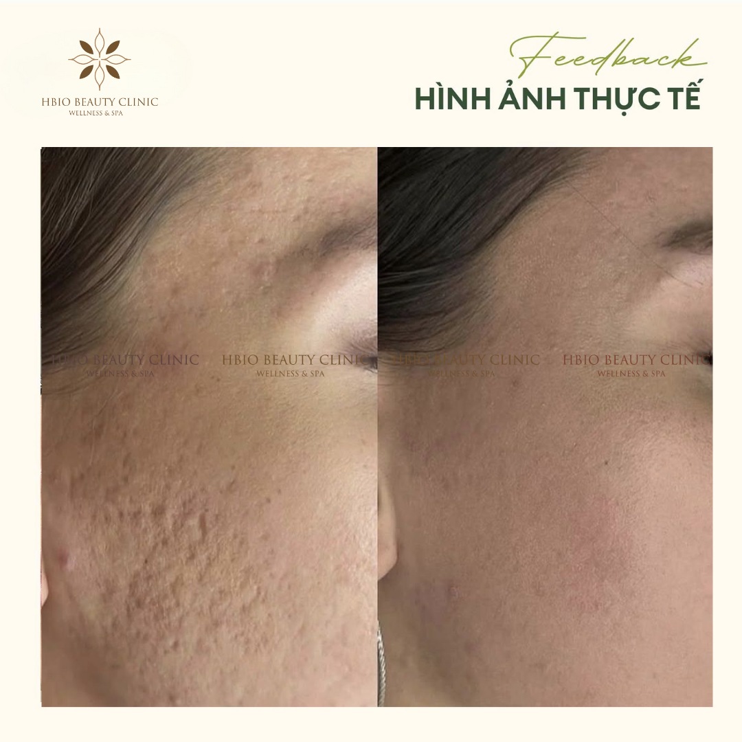 Điều trị sẹo thủy đậu tại HBIO Clinic