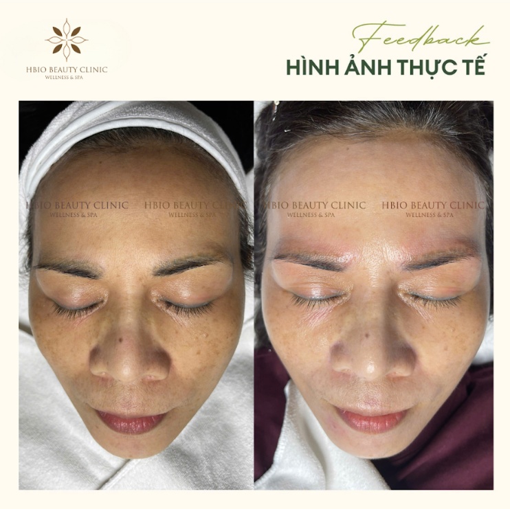 Điều trị tình trạng sạm da mặt bằng laser tại HBIO Clinic