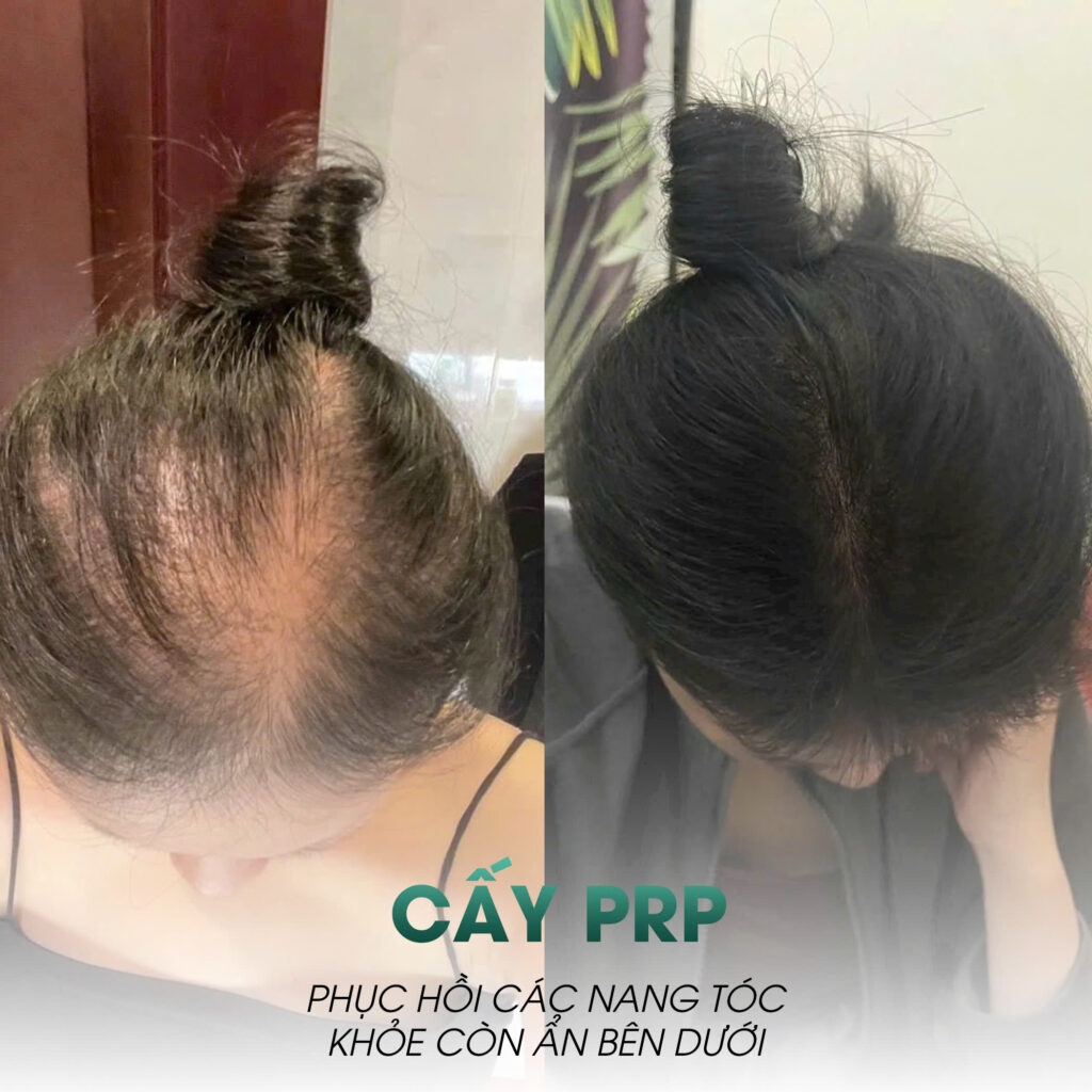Giá PRP tóc phụ thuộc nhiều yếu tố