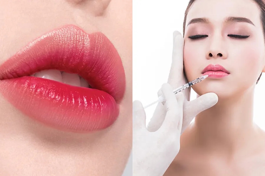 Hbio Clinic - Địa chỉ tiêm filler môi uy tín, chuyên nghiệp nhất hiện nay