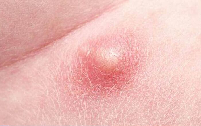 Không xử lý thì mụn chai có tự hết không?