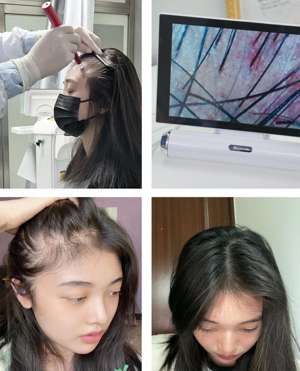 Lưu ý chăm sóc sau khi làm PRP tóc