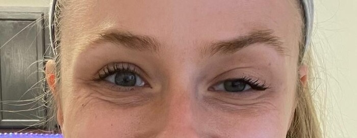 Lý do chính khiến tiêm botox bị sụp mí mắt