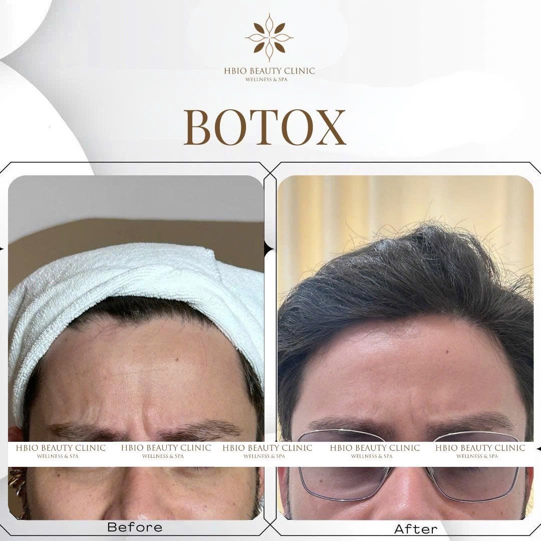 Meso Botox được đánh giá là phương pháp làm đẹp tương đối an toàn