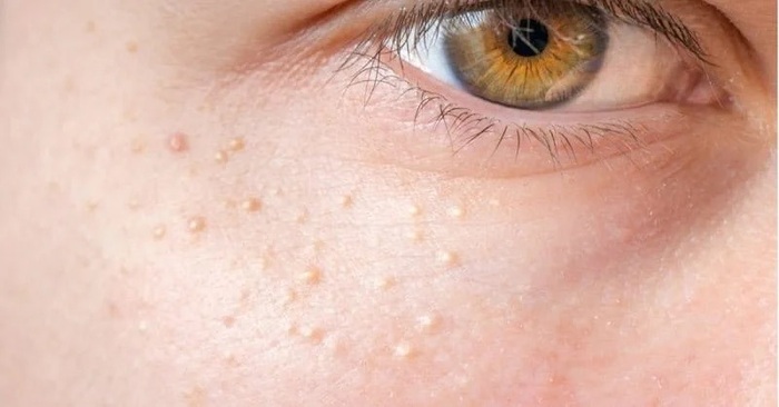 Mụn thịt có lây không và các lầm tưởng phổ biến