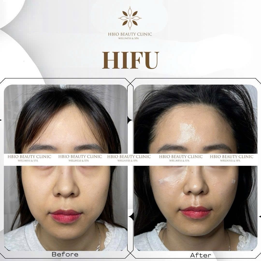 Nâng cơ dây chằng dưới da là gì?