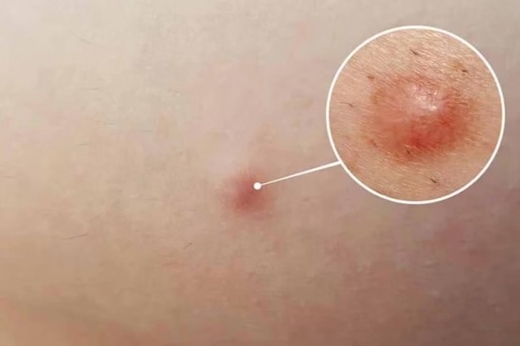 Nguy cơ tiềm ẩn nếu để mụn chai tồn tại quá lâu trên da