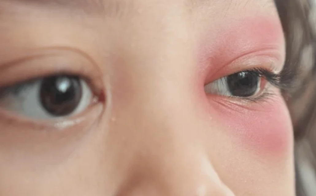 Nguyên nhân dẫn đến mí mắt bị sụp