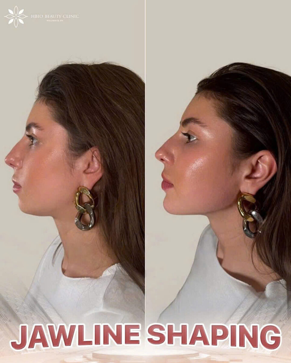 Nguyên nhân khiến tiêm botox gọn hàm bị hóp má