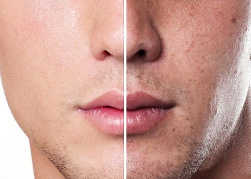Nguyên nhân tình trạng da sạm đen ở nam giới