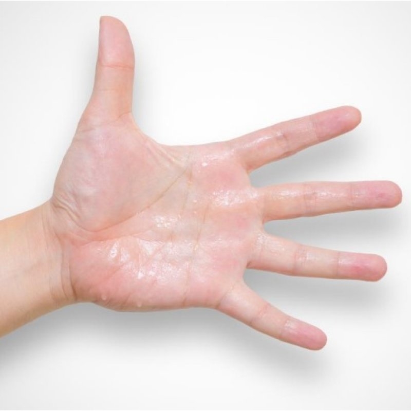 Nguyên nhân tình trạng mồ hôi tay