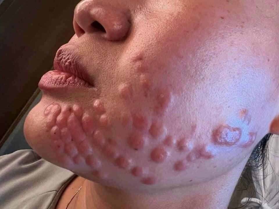 Những dấu hiệu bất thường cần gặp bác sĩ sau khi tiêm exosome 