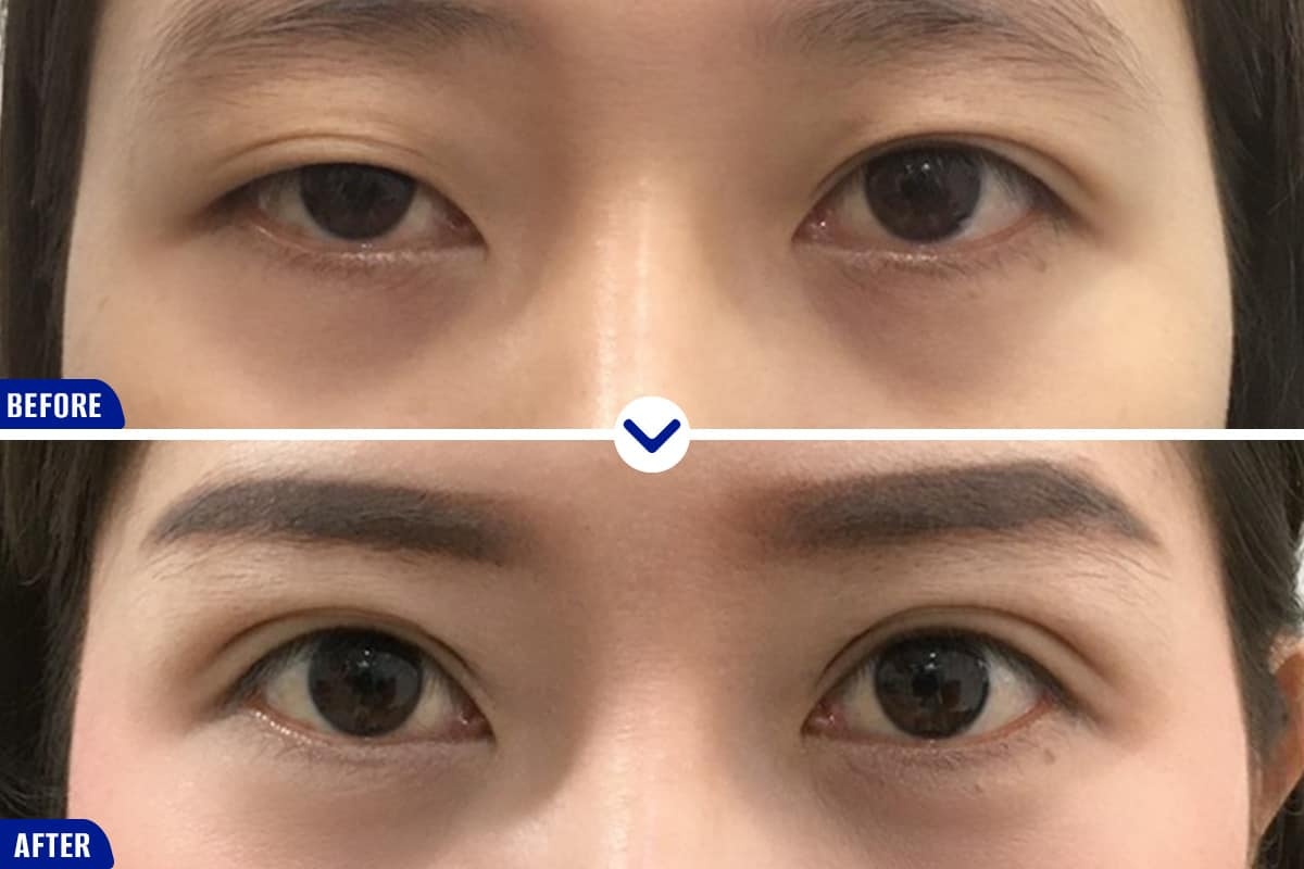 Những phương pháp khắc phục tình trạng mắt sụp mí