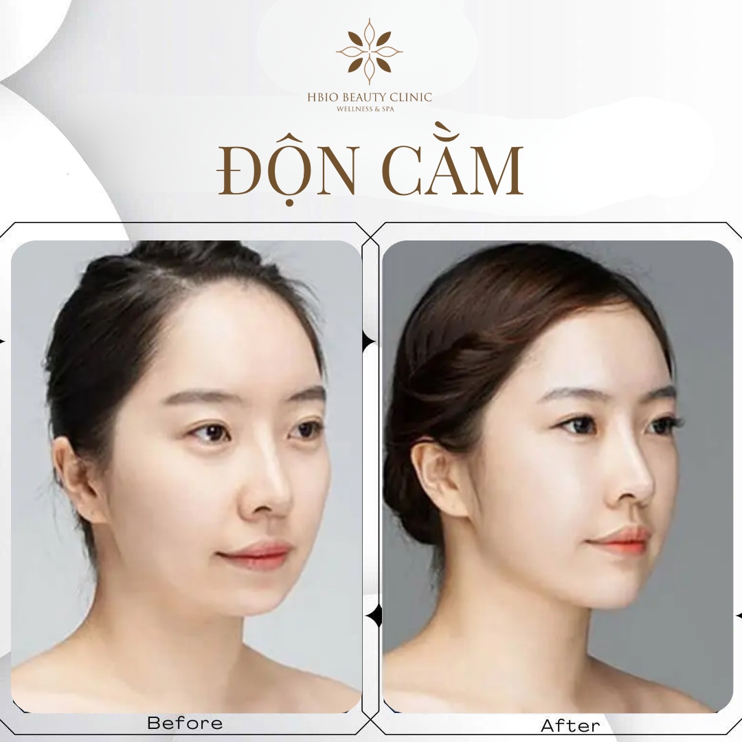 Những rủi ro tiềm ẩn khi tiêm filler đè lên miếng độn