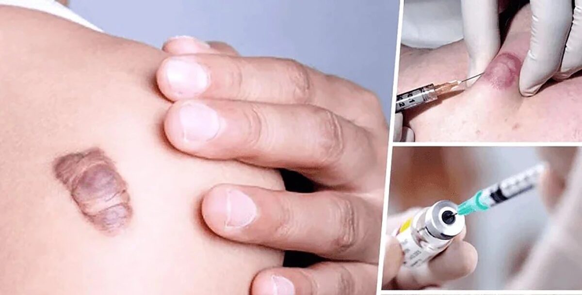 Phương pháp tiêm tan sẹo lồi mang lại hiệu quả cao