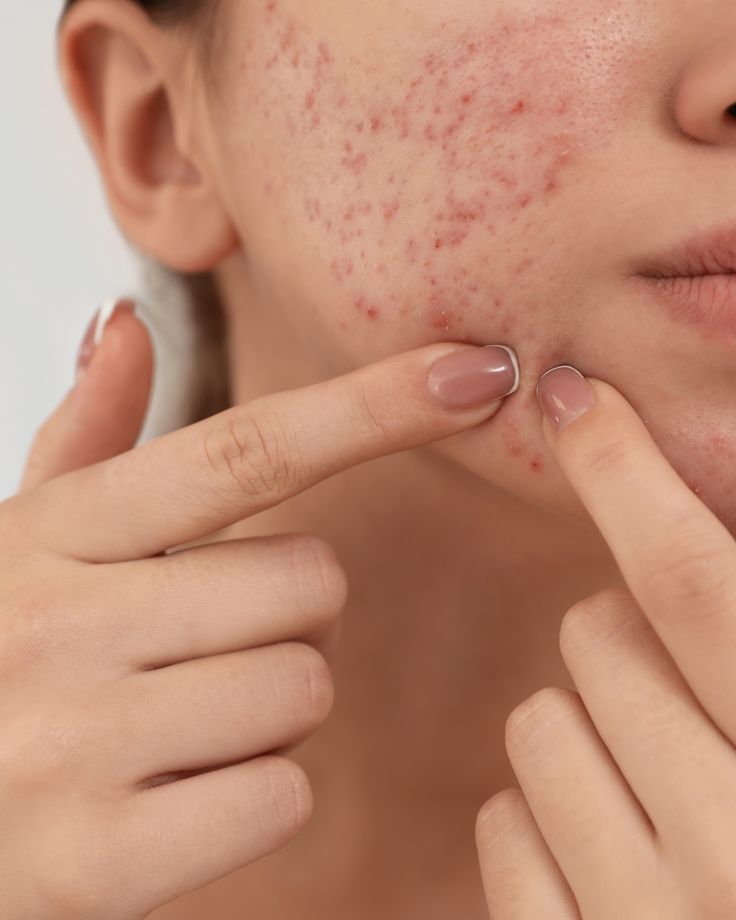 Sẹo lõm hình thành do mụn viêm nặng