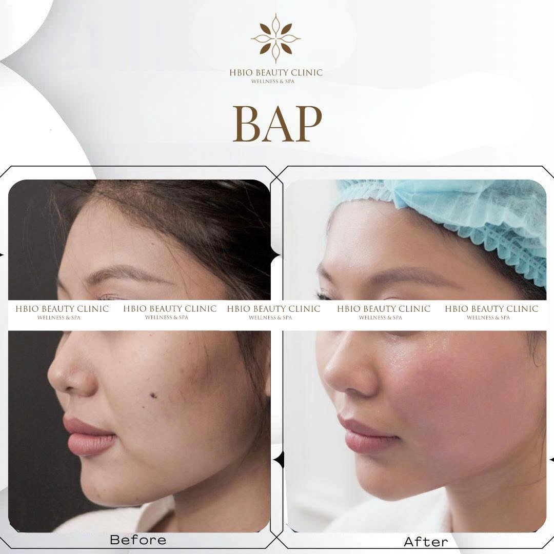 Tiêm BAP (Bio Aesthetic Points)