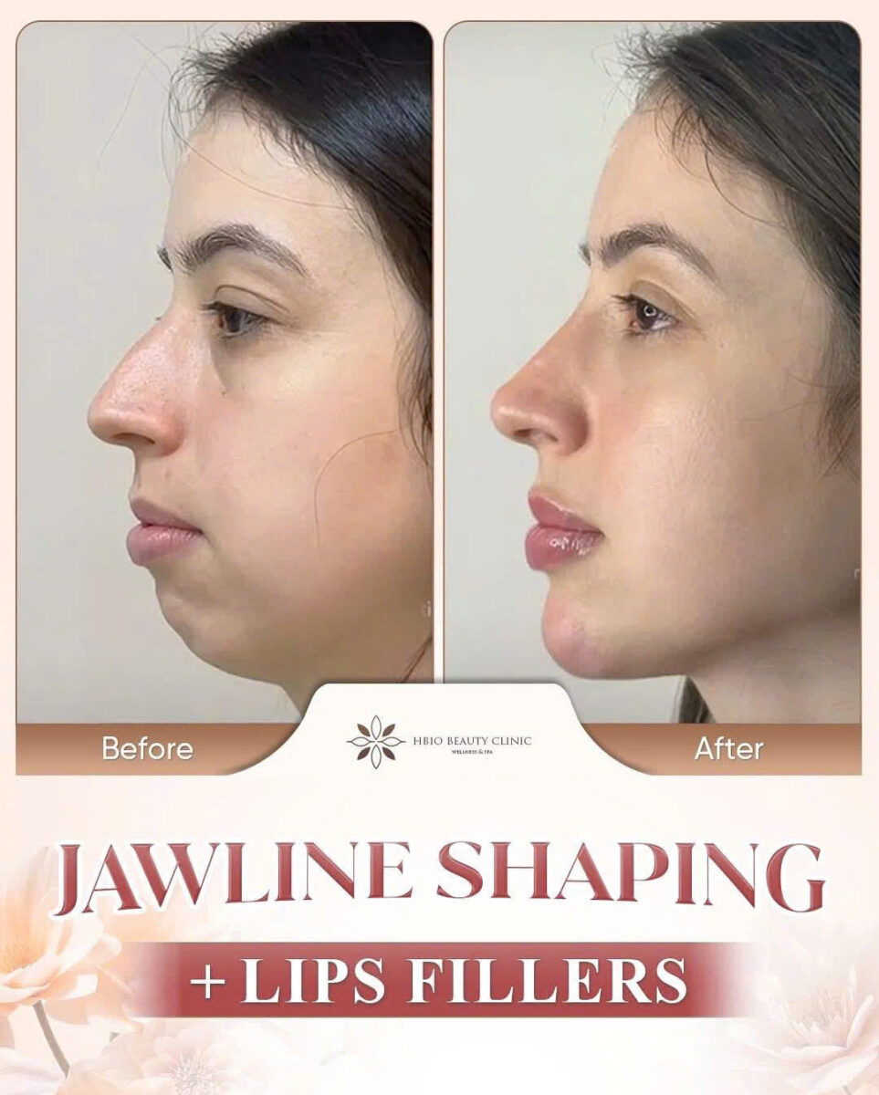 Tiêm botox gọn hàm bị hóp má