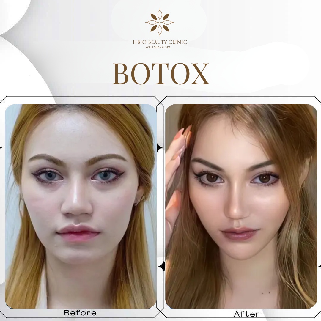 Tiêm botox mũi duy trì trong bao lâu?