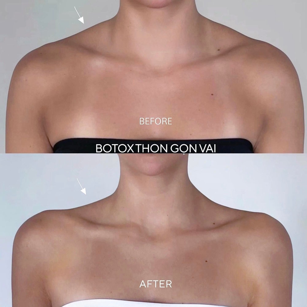 Tiêm botox thon gọn vai tại HBIO Clinic