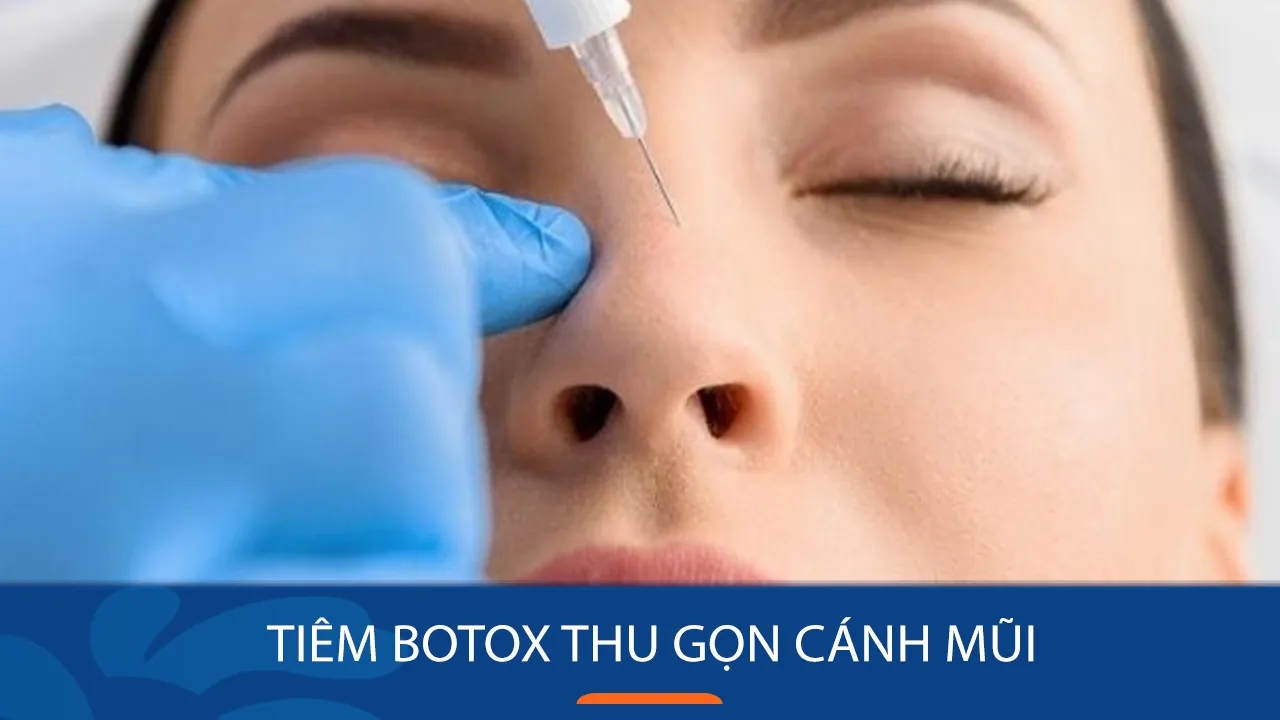 Tiêm botox thu gọn cánh mũi
