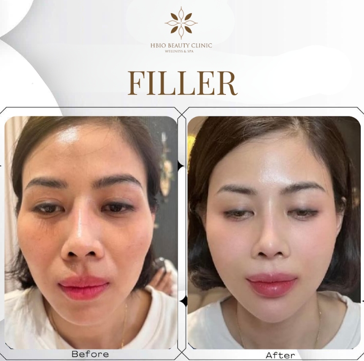 Tiêm filler điều trị rãnh mũi má tại HBIO Clinic