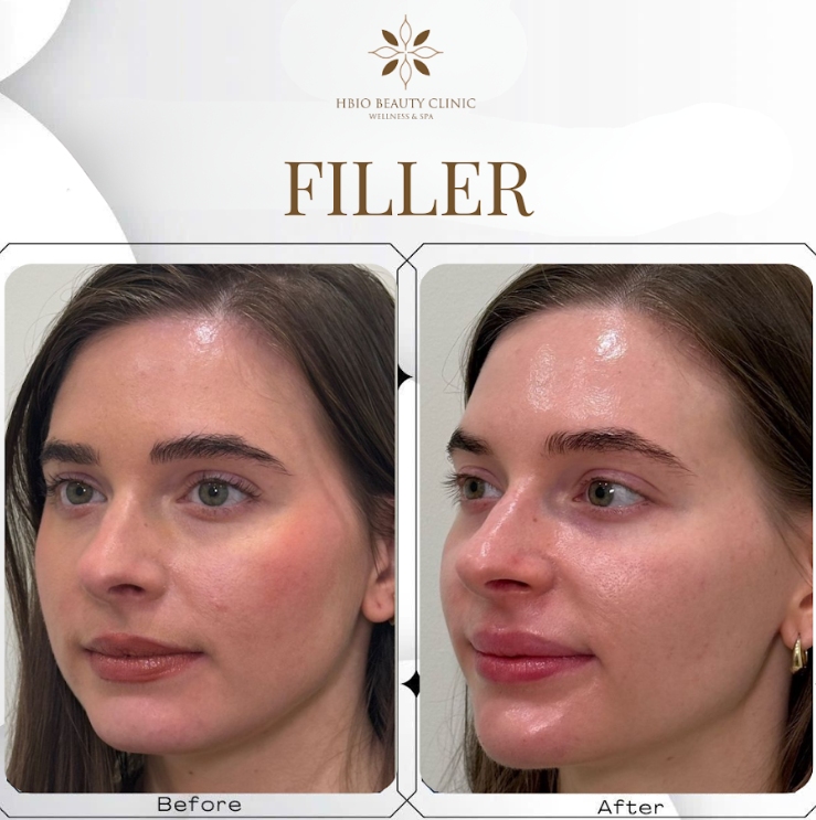 Tiêm filler tại HBIO Clinic