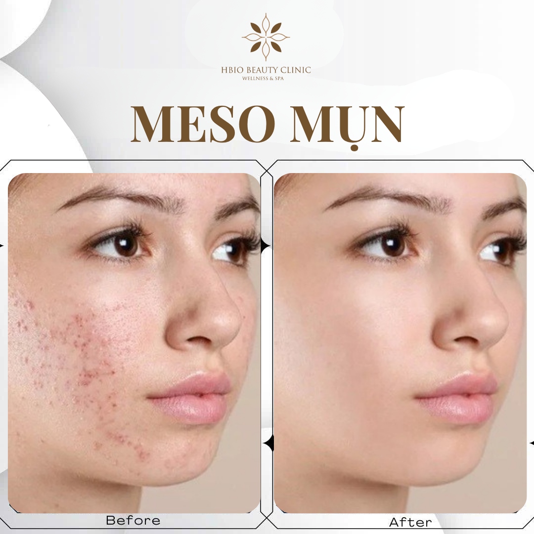 Tiêm meso giúp điều trị mụn và phục hồi vết thương