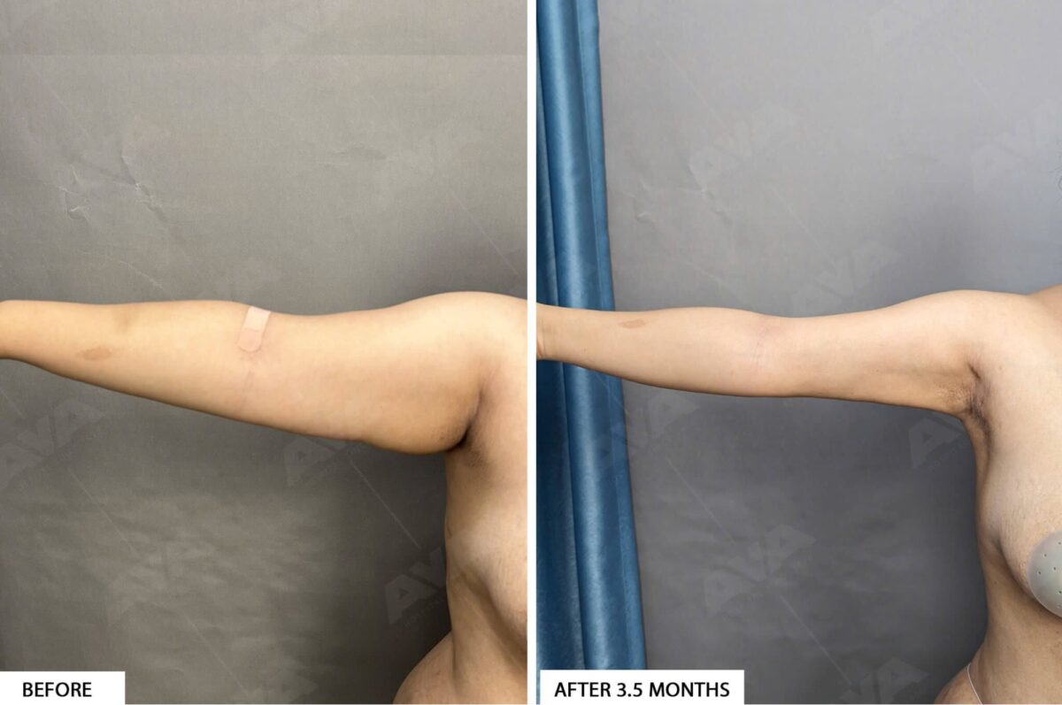 Tiêm tan mỡ vùng nách có hiệu quả không?