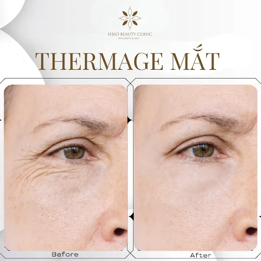 Trẻ hóa làn da bằng công nghệ Thermage tại Hbio Clinic
