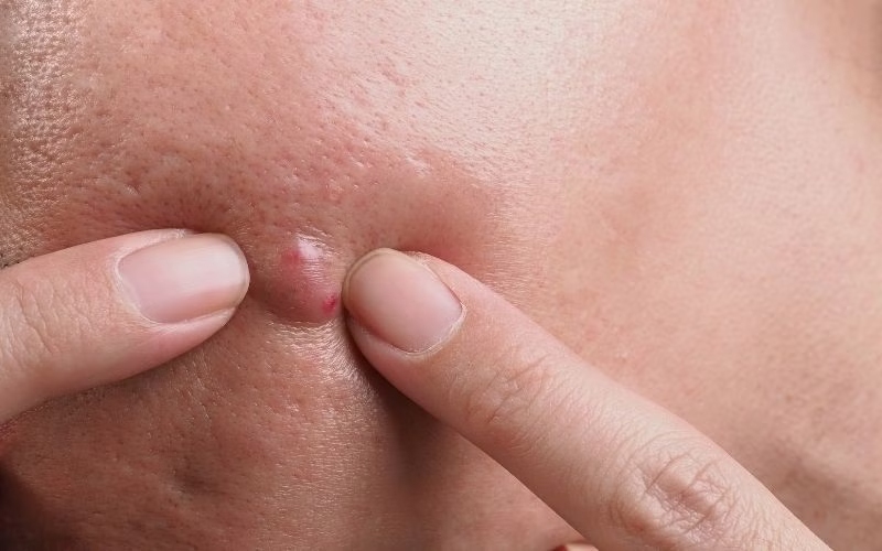 Xử lý mụn chai bằng công nghệ hiện đại