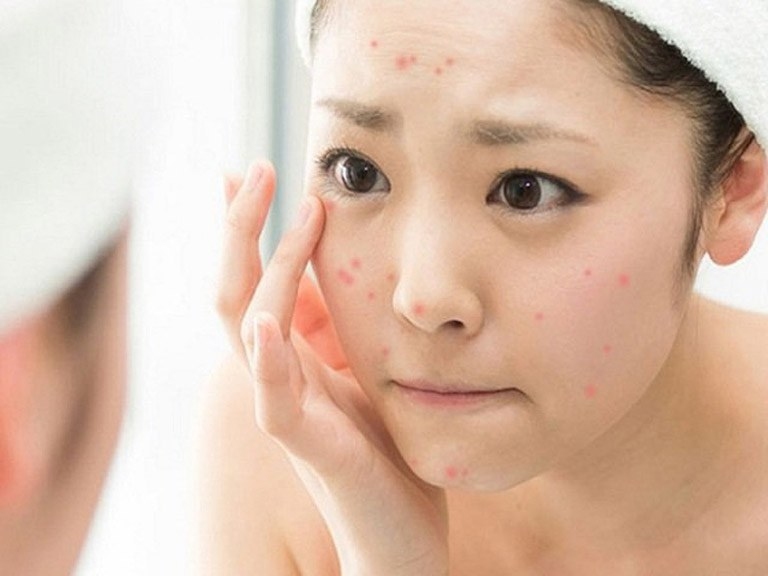 Bạn chỉ nên can thiệp khi nốt mụn đã thực sự chín