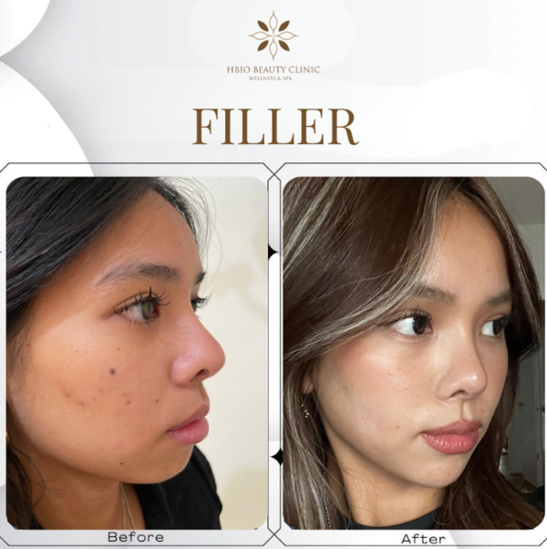 Tiêm filler cải thiện cằm lẹm tại HBIO Clinic