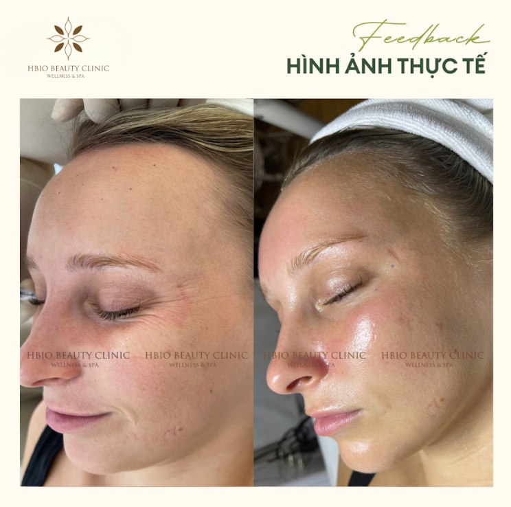 Chăm sóc da sau khi peel tại HBIO Clinic
