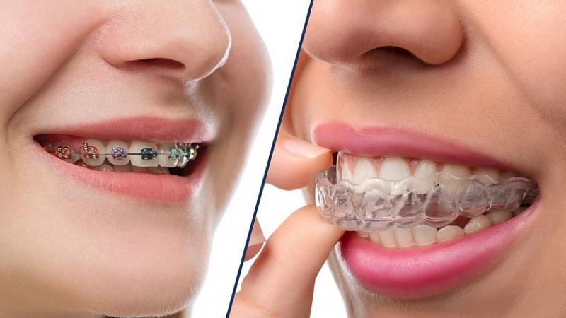 Chỉnh nha và can thiệp xương hàm