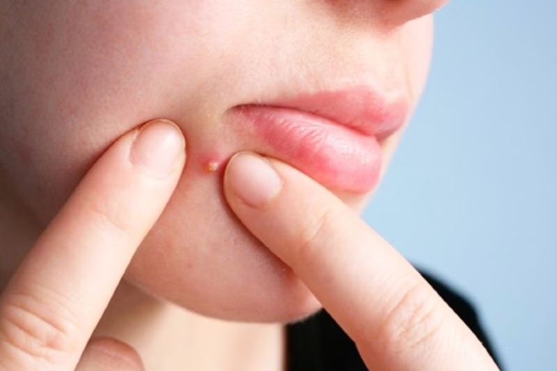 Có nên nặn mụn mủ không