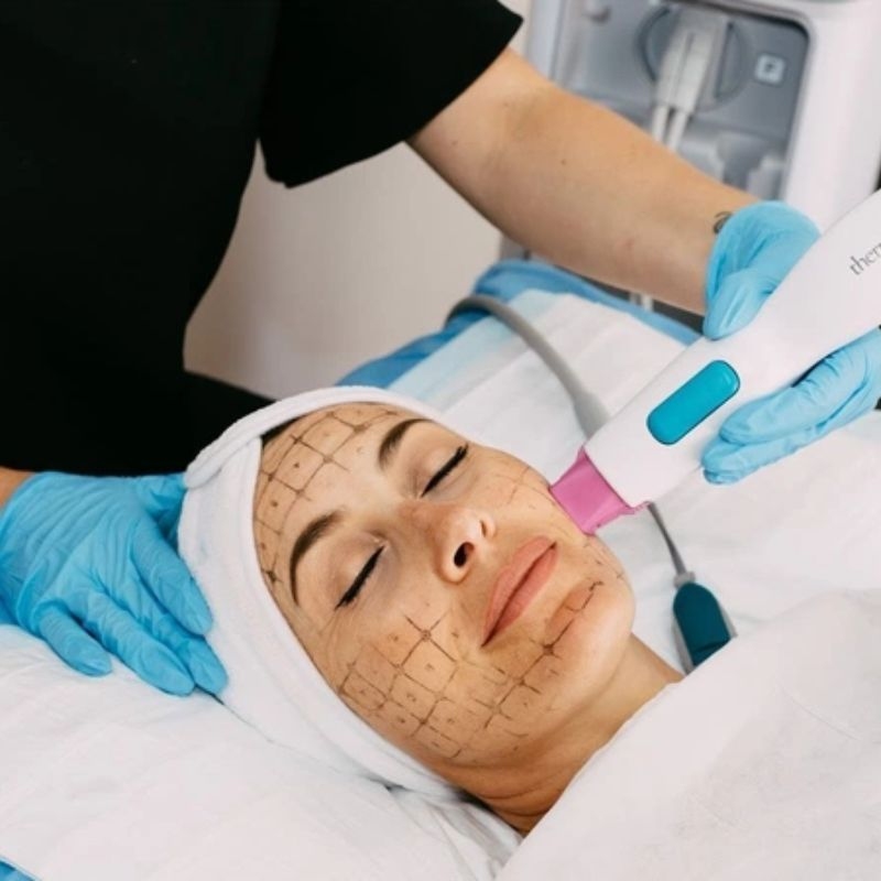 Công nghệ thermage flx giữ được bao lâu?
