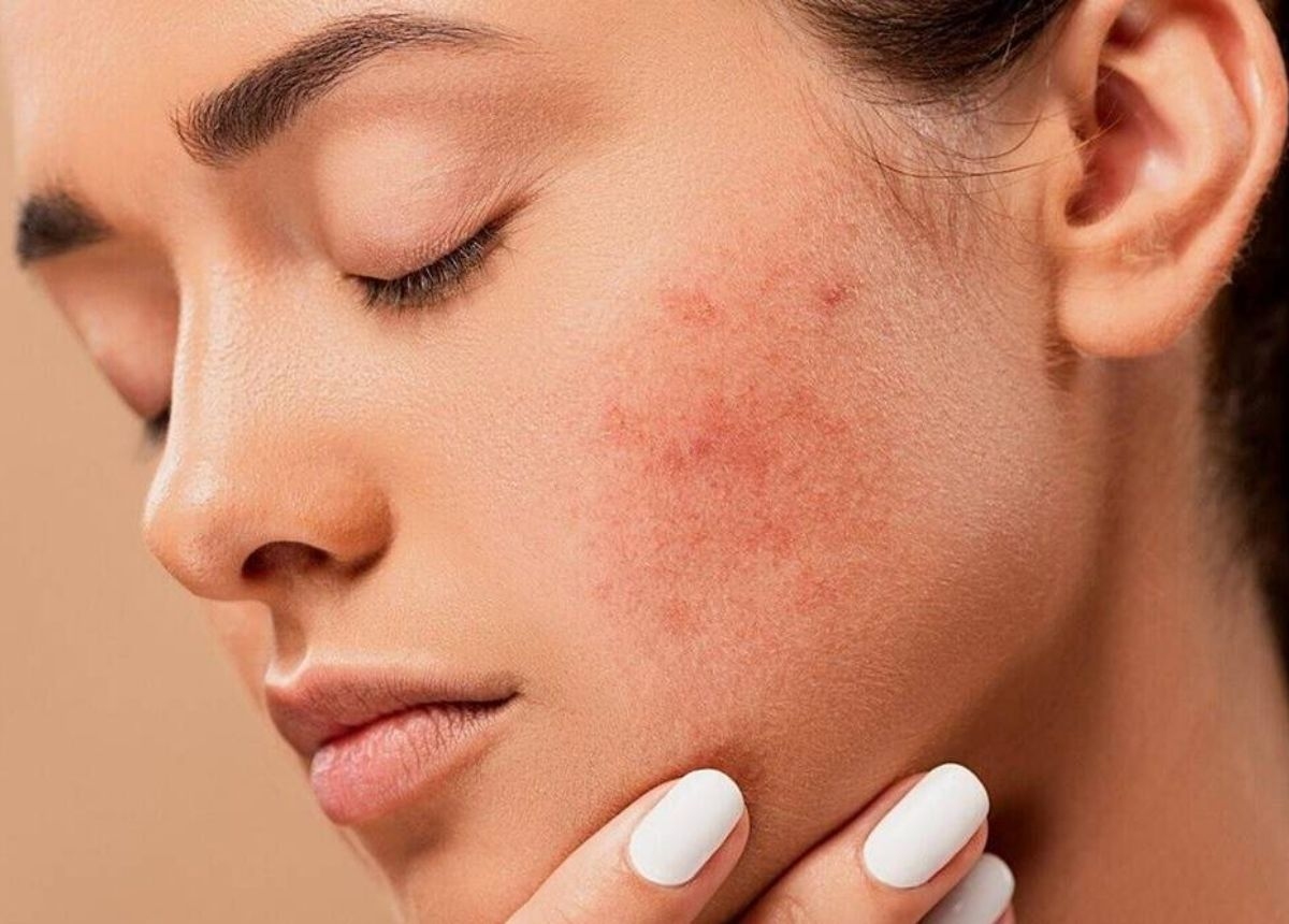 Dấu hiệu nhận biết viêm da cơ địa