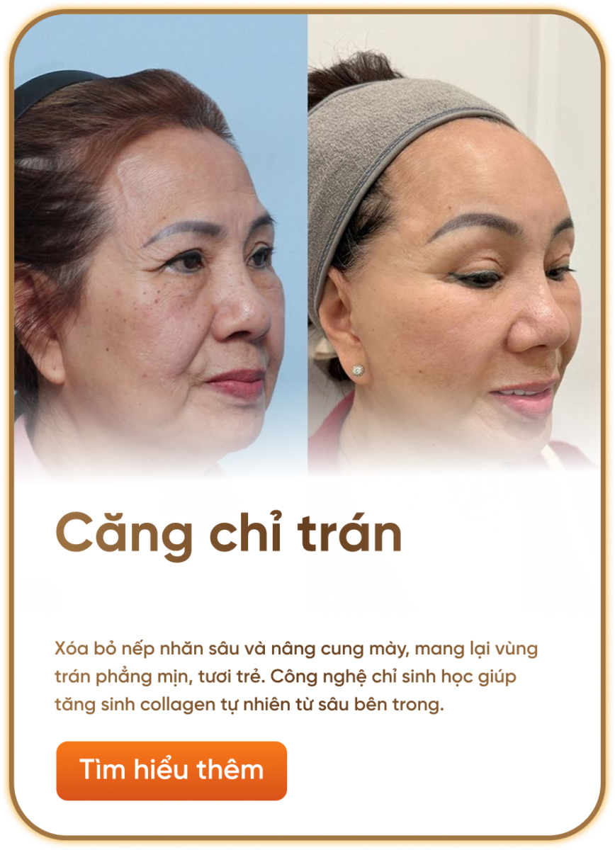 căng chỉ trán
