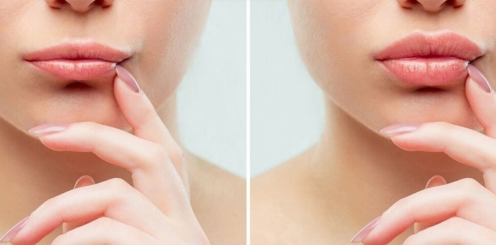 Điều chỉnh cân đối tỉ lệ môi - mũi - cằm