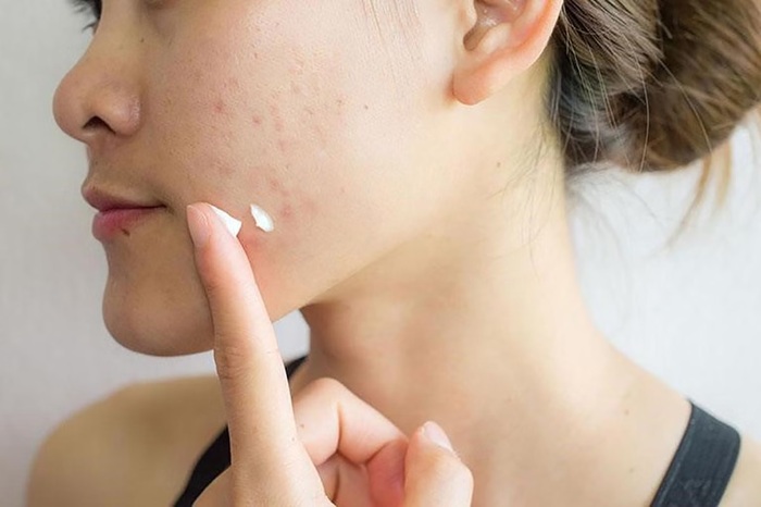 Dùng thuốc bôi có chứa axit salicylic