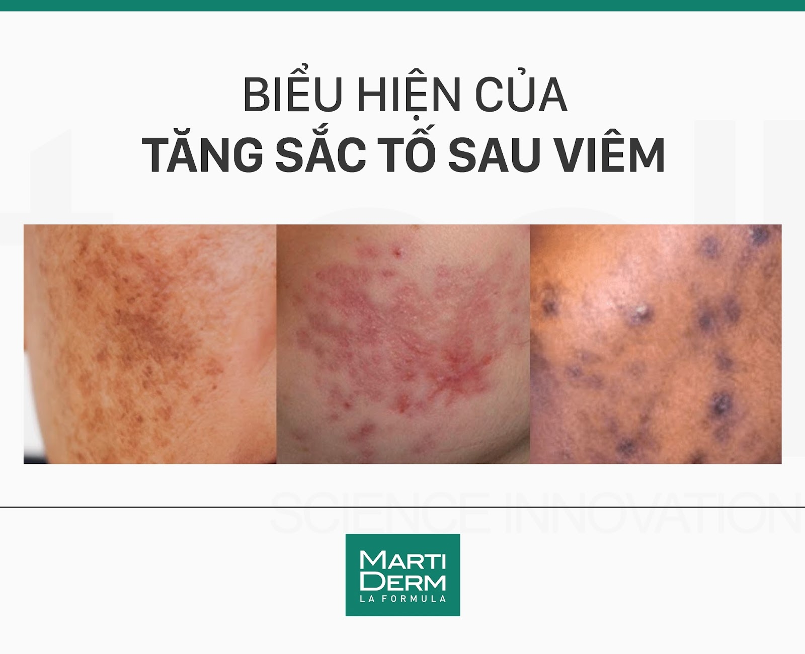 Giảm sắc tố sau viêm là gì?