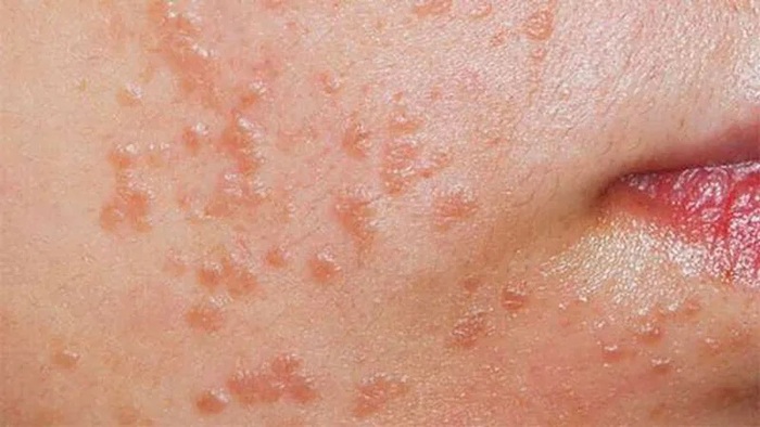 Hạt cơm phẳng là gì và dấu hiệu nhận biết điển hình