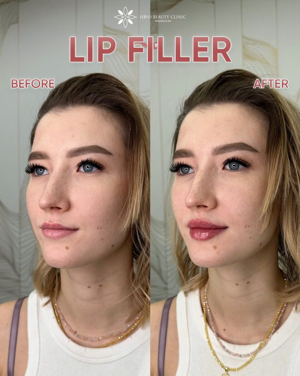 HBIO Clicnic - filler môi