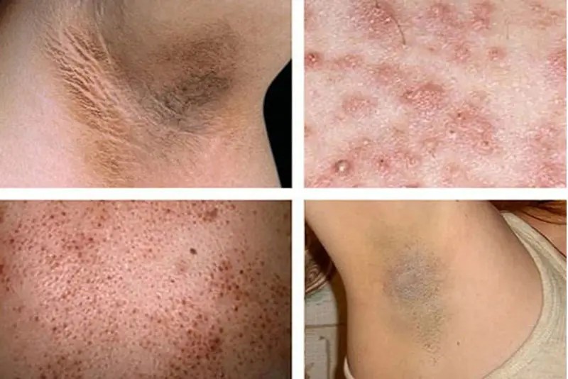 Hệ quả của việc triệt lông tại nơi chất lượng kém