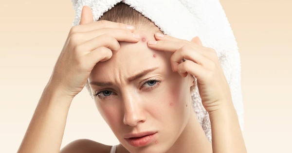 Hướng dẫn cách nặn mụn mủ đúng cách tại nhà 