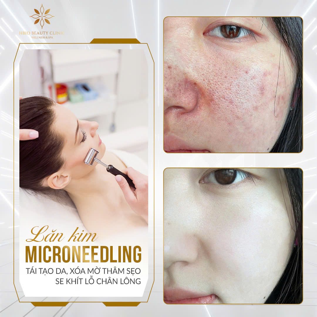 Lăn kim kết hợp dưỡng chất tái tạo